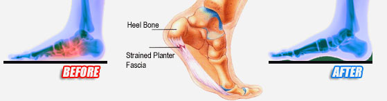 heel pain and plantar fasciitis
