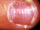 Alopecia Acreata Nails